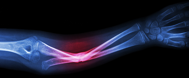 X-ray of a broken radius (arm)