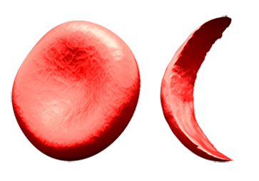 Normal Red Blood Cell and Sickle Cell