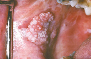 Leukoplakia