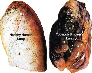 healthy lung versus smoker's lung