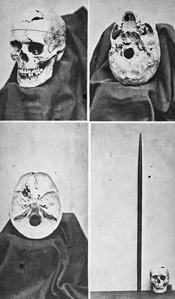 images of Phineas Gage's skull